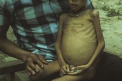 Un bambino malato. Aveva malaria, tubercolosi, dissenteria e ascaridi. Il grosso ventre è dovuto al rigonfiamento del fegato a causa della malaria e ai vermi. Era troppo grave, non fu possibile curarlo